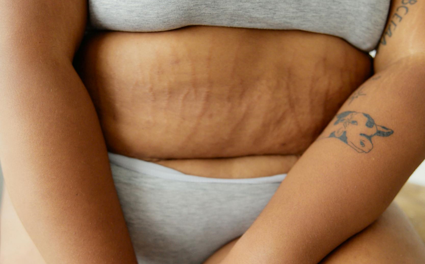 Menopausa E Obesidade